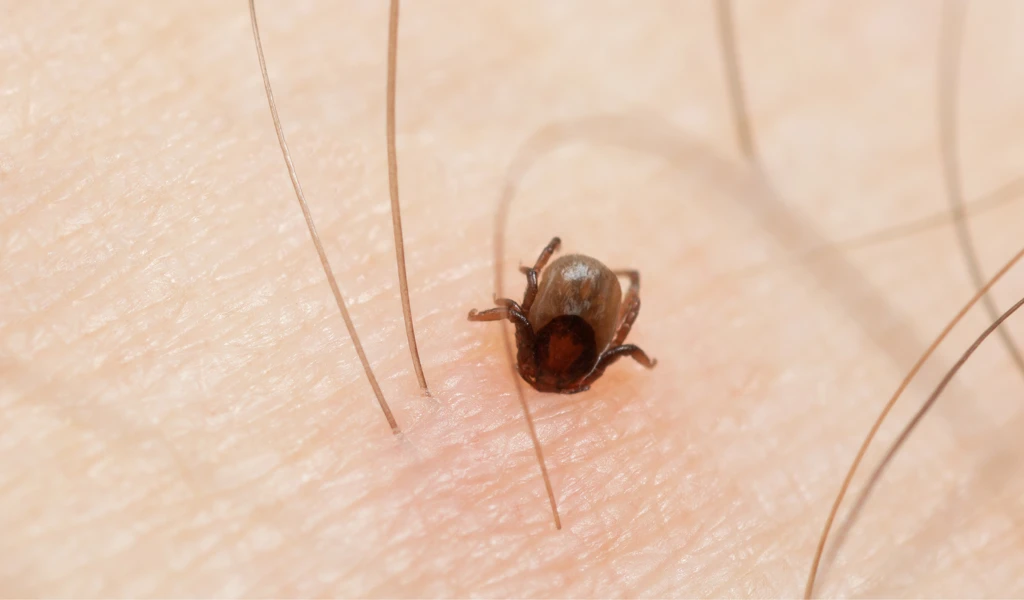 close up photo of a tick burrowed into human skin
